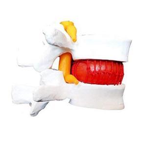 ARELENE Anatomical Human Lumbar Vertebrae Degenerative Lumbar Human Spine Model 1PCS